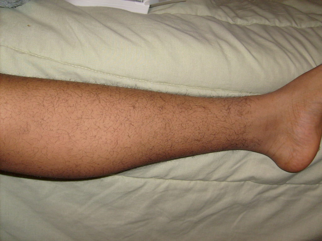 Restless Leg Syndrome 1024x768 
