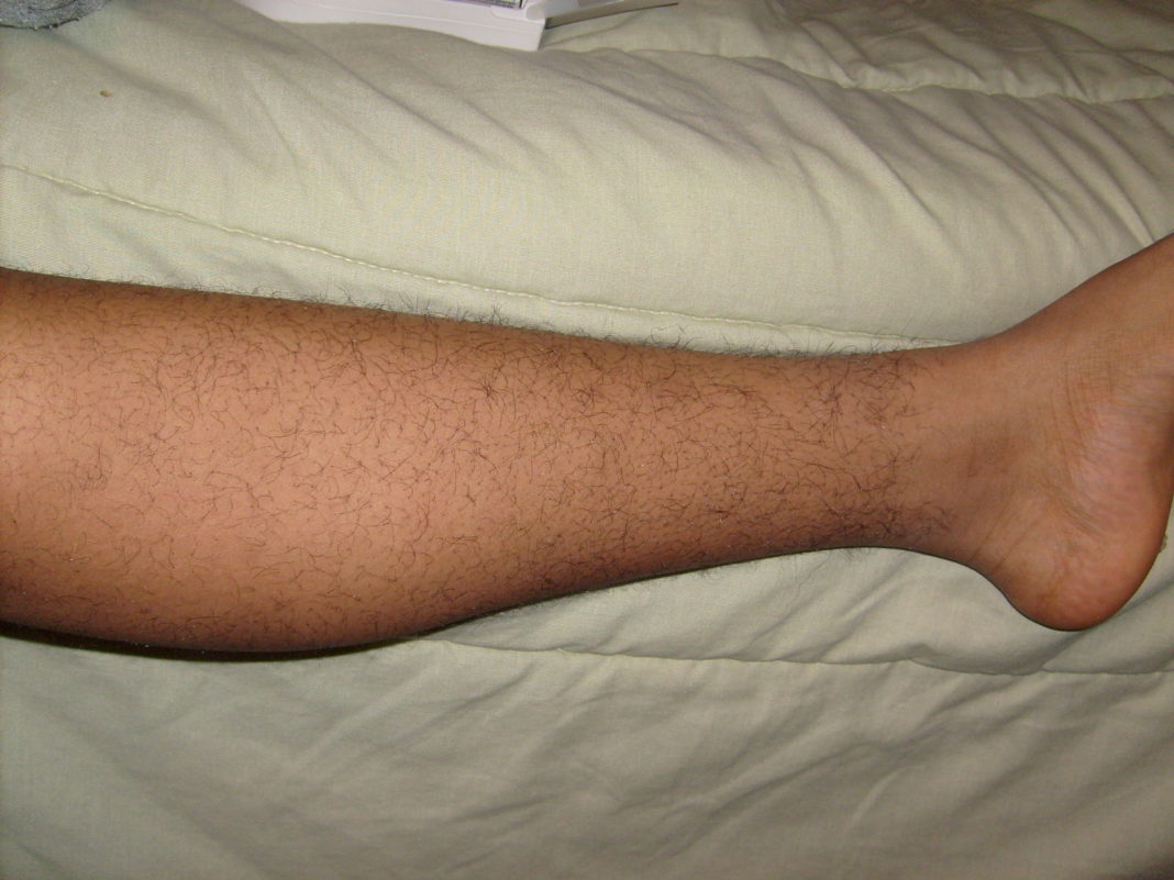 Restless Leg Syndrome 1068x801 